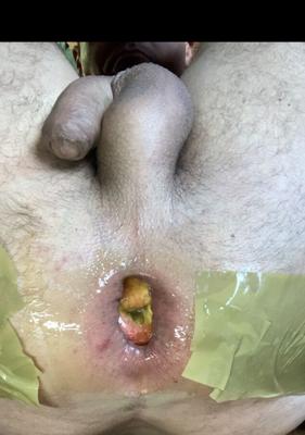 Extreme anal Apple insertion destroyed